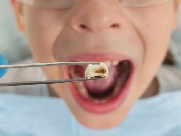 Best Emergency Treatment for Dental Infections or Abscesses in Newark, IL