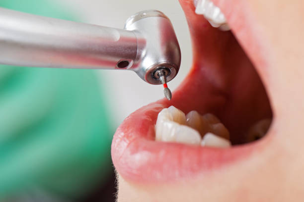 Best Urgent Care for Lost Fillings or Crowns in Newark, IL
